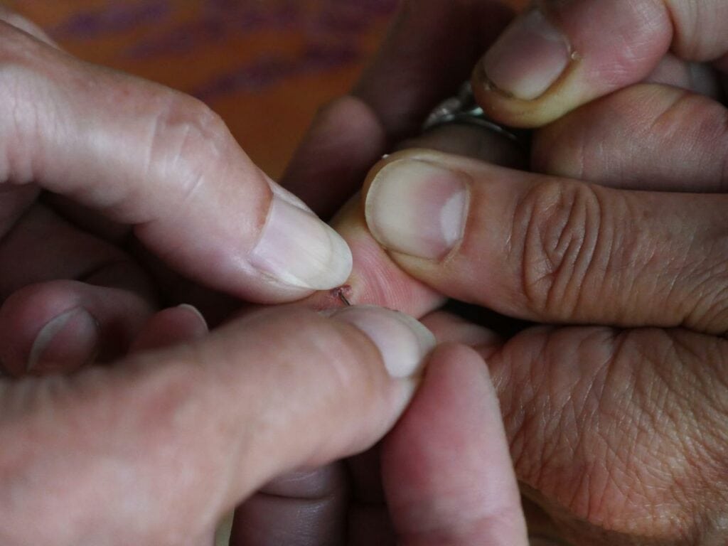 removing splinter from a hand