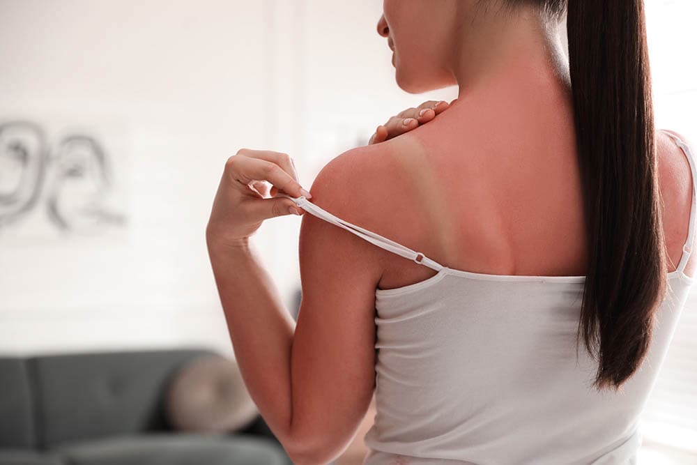 Woman with sunburned skin at home