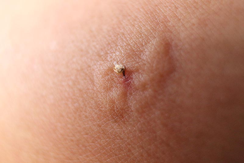 bee sting wound on a man's arm
