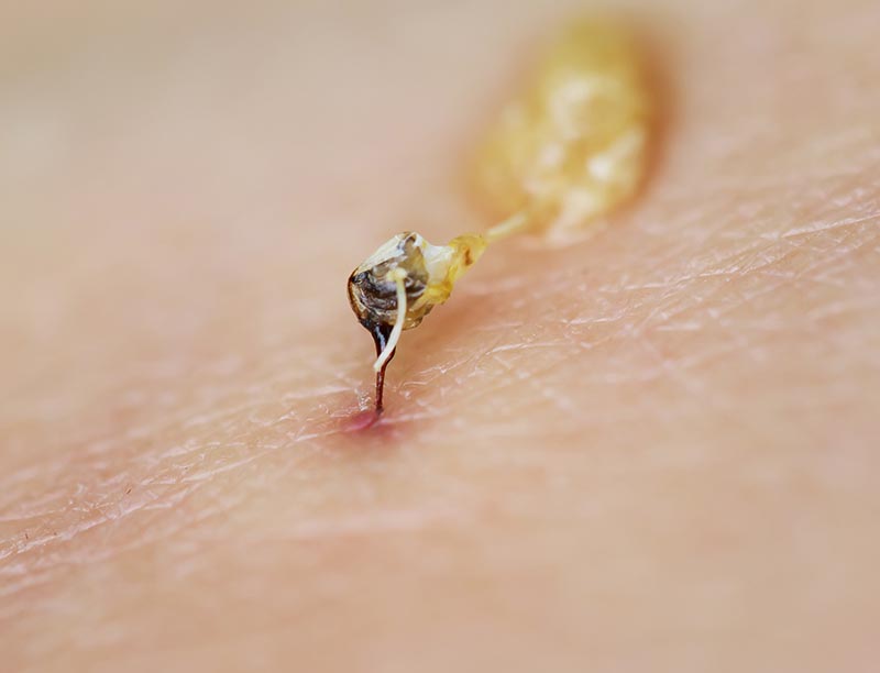 close up poisonous bee sting on the skin