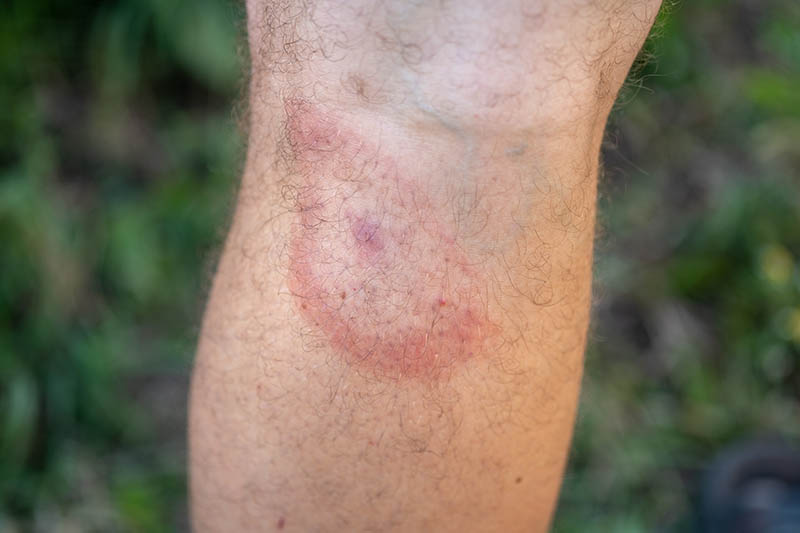 tick bite on mans leg