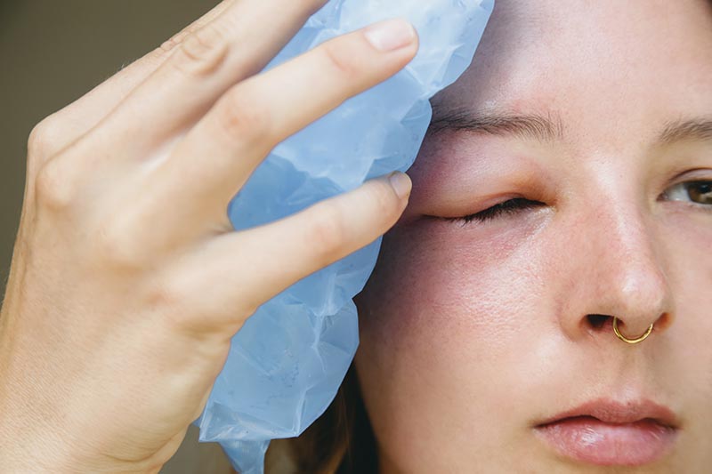 woman with swollen eye from bee sting